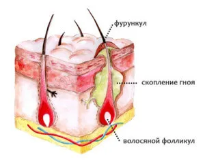 фурункульоз і як його лікувати