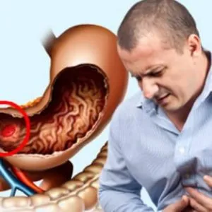 допоможіть лікувати ерозивний гастрит