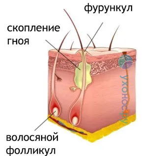 як лікувати фурункул в носі