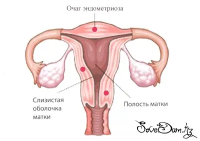 Ендометріоз - здоров'я жінки як лікувати ендометріоз після аборту