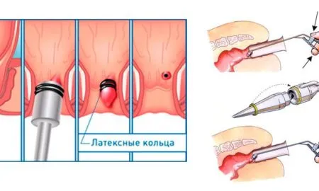як лікувати геморой у жінок народними засобами