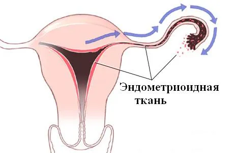 як лікувати екстрагенітальний ендометріоз