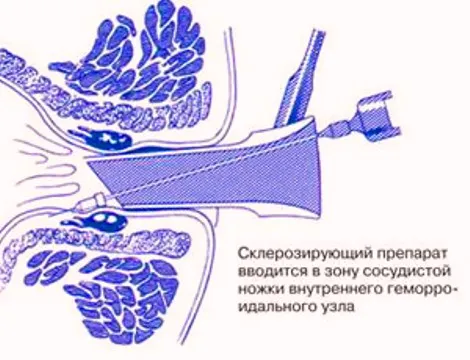 як лікувати геморой у жінок народними засобами