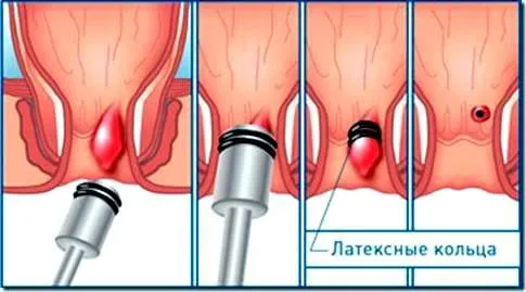 як вилікувати геморой 2 стадії