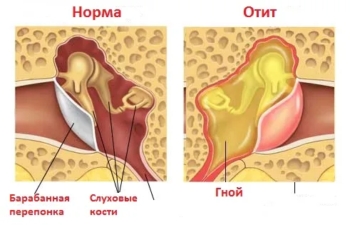 Фурункул у вусі: лікування і симптоми фурункул