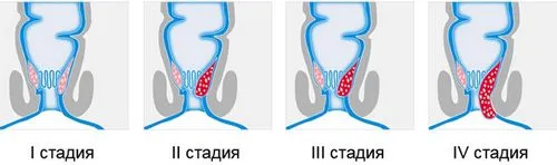 Геморой 3 стадії (комбінований, хронічний) - лікування, операція чи можна вилікувати геморой 2 ступеня