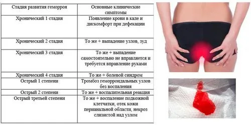 як лікувати геморой у жінок народними засобами