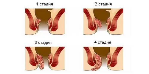 як лікувати геморой 4 стадії