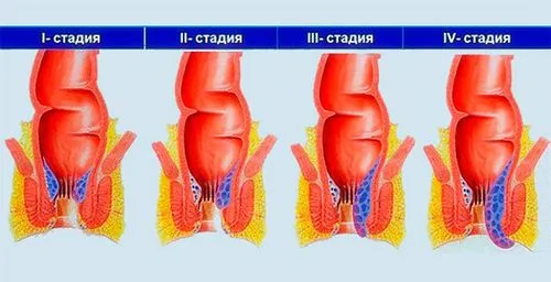 Геморой 2 ступеня, як лікувати як лікувати хронічний геморой 2 ступеня