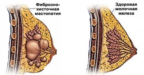 лікувати фіброзну мастопатію