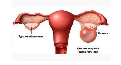 як лікувати фолікулярну кісту народними засобами