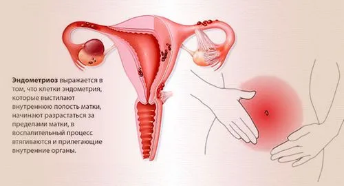 як лікувати ендометріоїдних кісти