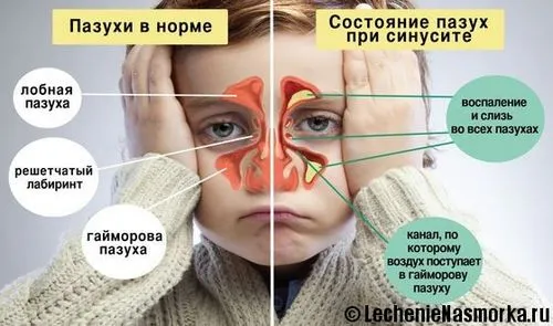 як лікувати хронічний синусит у дітей