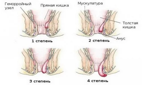 як вилікувати геморой 2 стадії