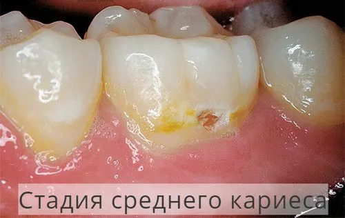 атрофія кісткової тканини