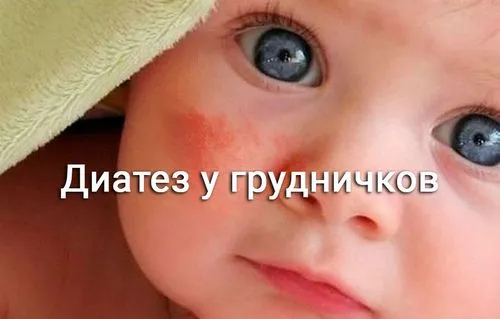 лікувати діатез у грудних дітей