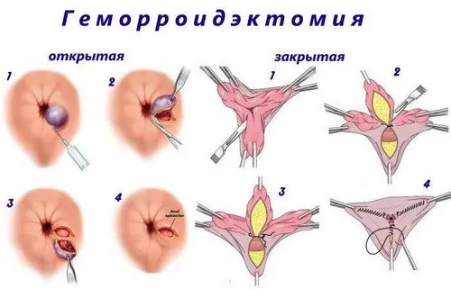 як лікувати геморой 4 стадії