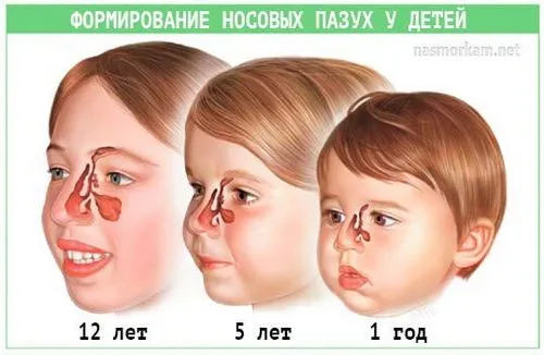 Гайморит у дитини: симптоми і лікування в домашніх умовах як лікувати гайморит у дітей