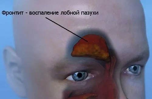 як лікувати фронтит у дітей