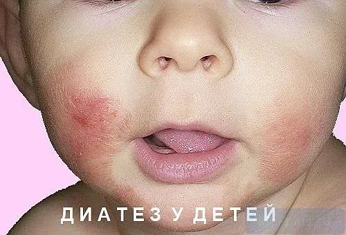 ексудативний діатез