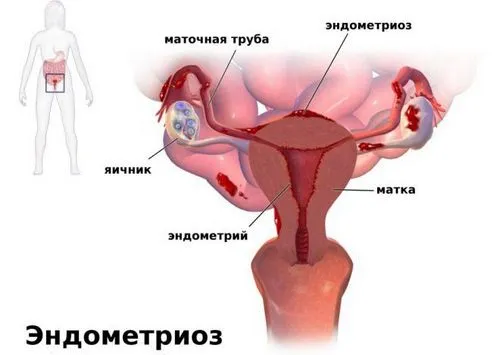 як лікувати хворобу ендометріоз