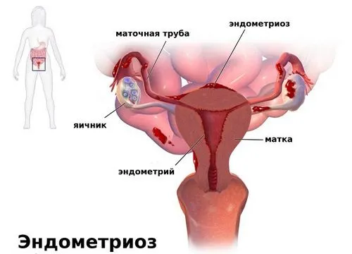 як лікувати ендометріоз народними засобами