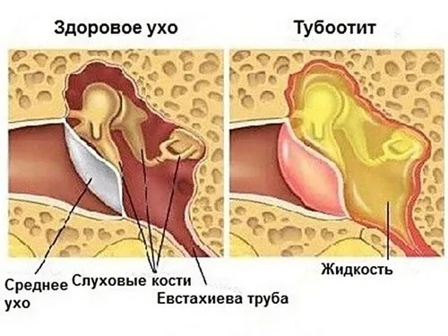 як довго лікувати тубоотит