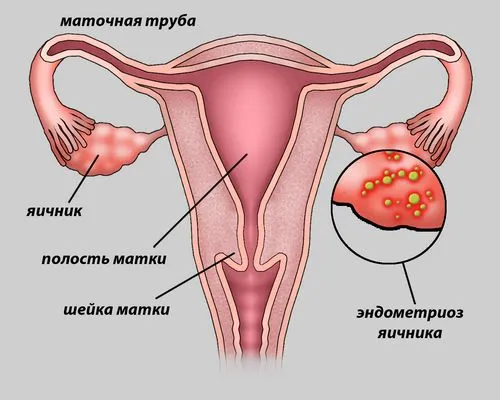 чи можна вилікувати ендометріоз вагітністю