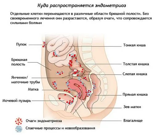 як лікувати хворобу ендометріоз