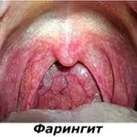 як вилікувати гнійний фарингіт