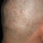 як вилікувати прищі в волоссі