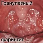 як лікувати гранулезний фарингіт