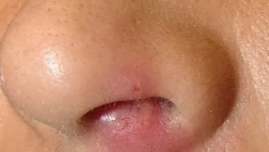 прищі на голові
