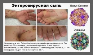 вірусний стоматит