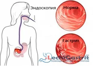 як лікувати печію шлунка