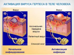 лікування герпетичного стоматиту у дорослих