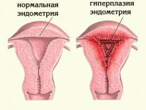 як лікувати ендометріоз поліп або гіперплазія ендометрію