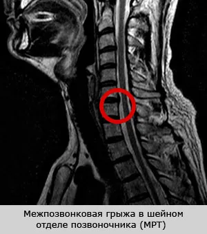 як лікувати грижу шиї