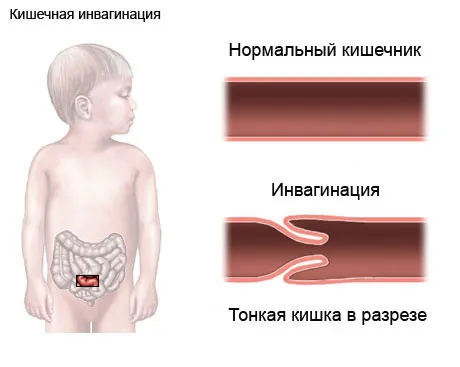 ніж лікувати дисбактеріоз кишечника у дітей