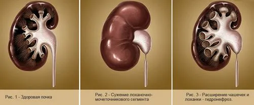 дієта при гідронефрозі нирки