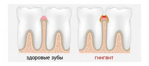 як швидко вилікувати ясна