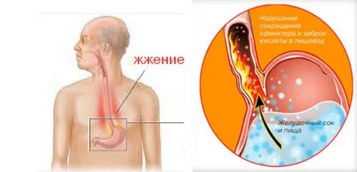 Печія - причини лікування phosphalugel