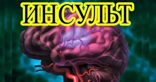 як лікувати інсульт головного мозку