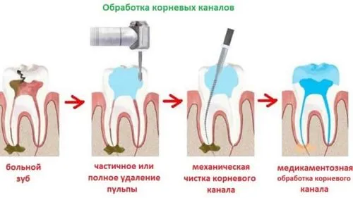 лікувати глибокий карієс