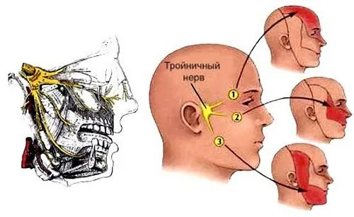 хронічний гайморит головний біль