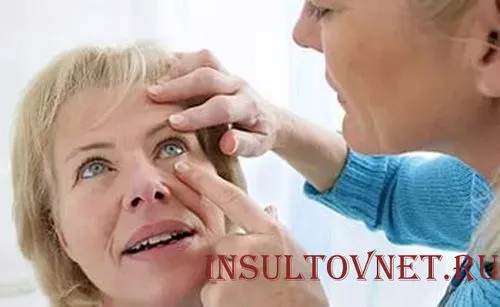 Інсульт очі його діагностика та різновиди як лікувати очної інсульт