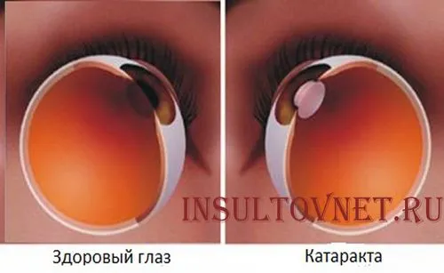 Інсульт очі його діагностика та різновиди як лікувати очної інсульт