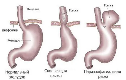 Грижа шлунка: симптоми і лікування як лікувати грижу шлунку народними засобами