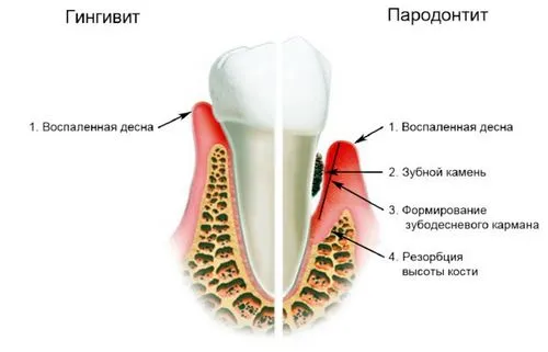 гінгівіт дітей причини симптоми лікування ускладнення полоскання гель холісал гострий гипертрофический некротичний температура стоматит карієс лікувати дитину