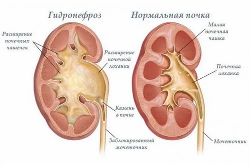 Гідронефроз нирок: що це таке? Симптоми і лікування гідронефрозу правої і лівої нирки гідронефроз нирок правої лівої симптоми лікування дітей вагітності